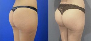 Lipofilling fessier Pour un beau derrière galbé