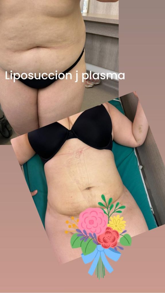 chirurgie esthétique liposuccion tunisie prix