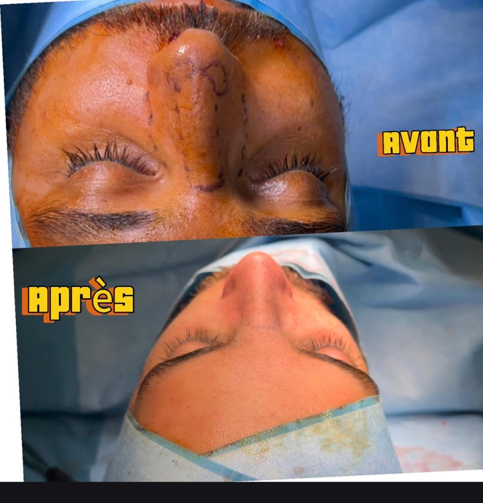 rhinoplasite tunisie docteur abidi